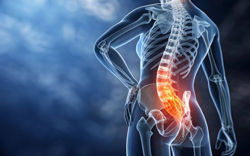 3D image showing lower back pain during sciatica treatment